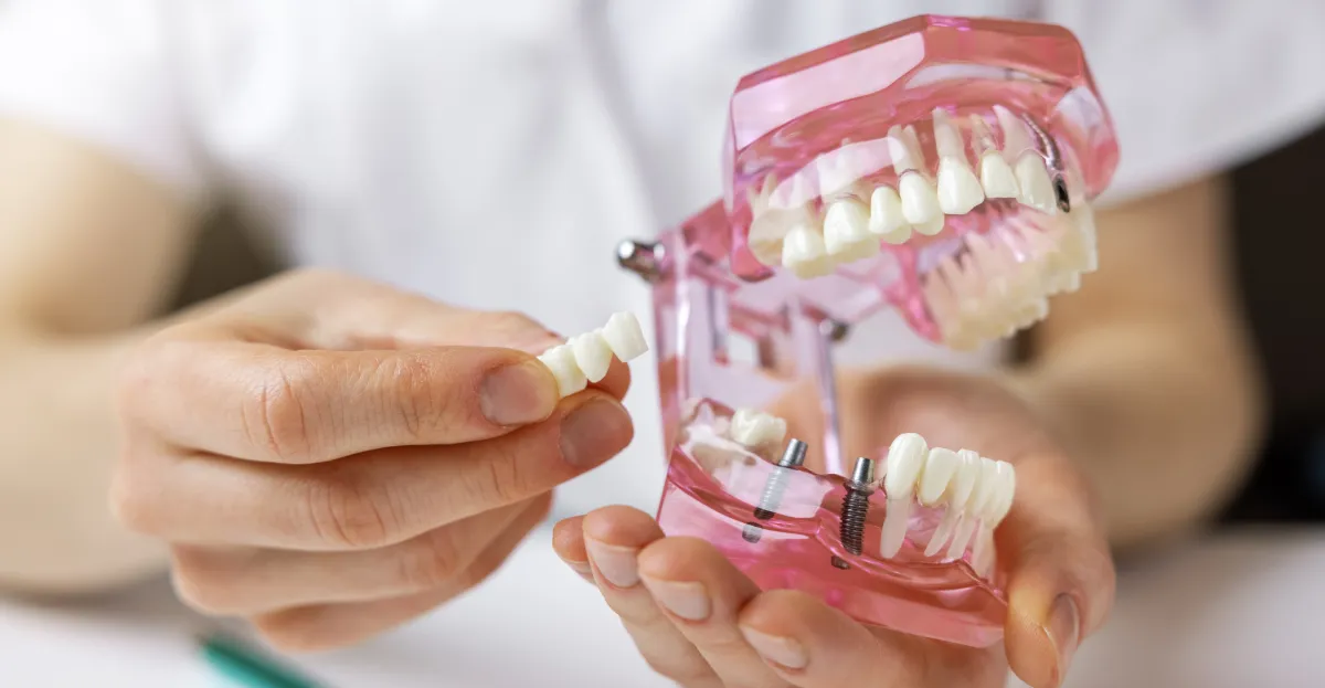 Dental Implants in Arlington: A Step-by-Step Guide