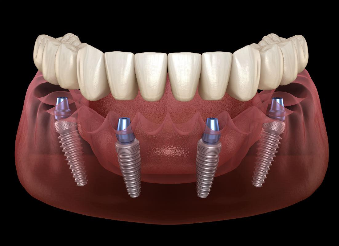 All-On-4 Dental Implants Arlington, VA